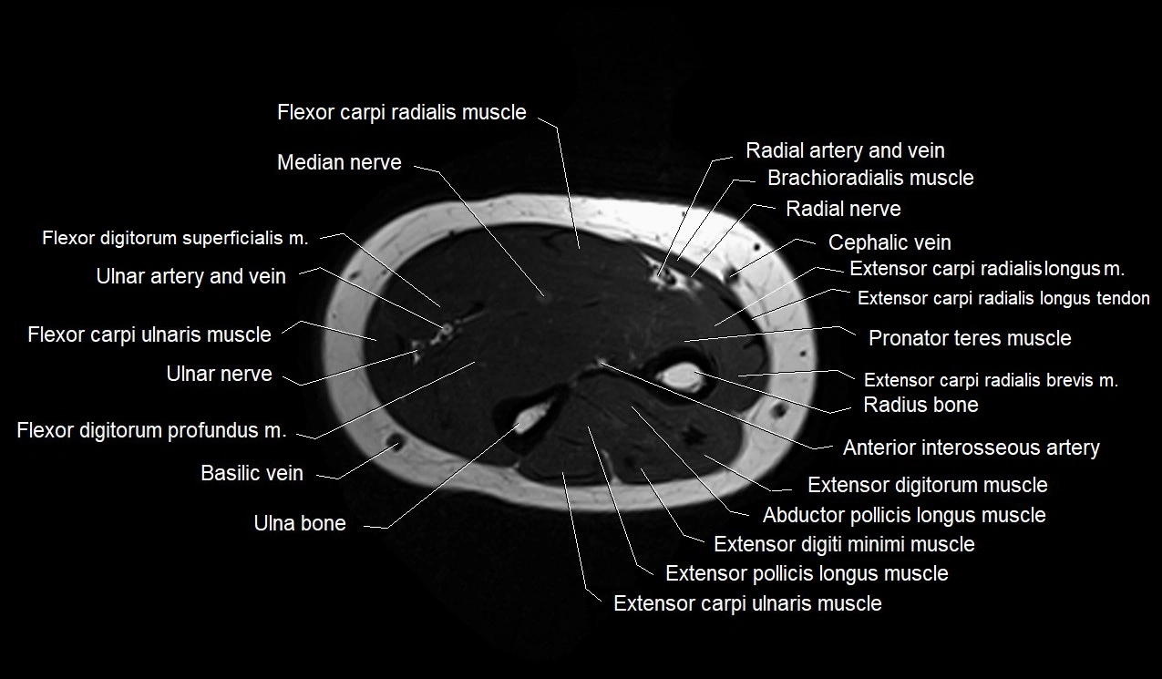 MRI 3T forearm axial cross sectional anatomy image 26.webp